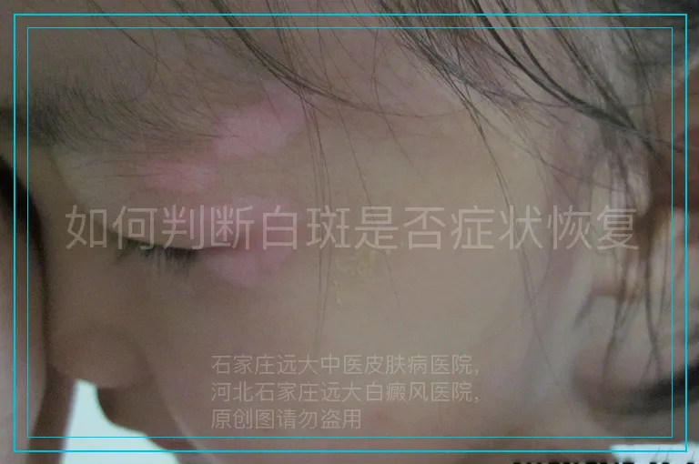 如何判断白斑是否症状恢复