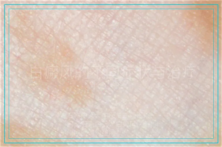 白癜风的不同症状与治疗