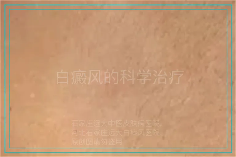 白癜风的科学治疗