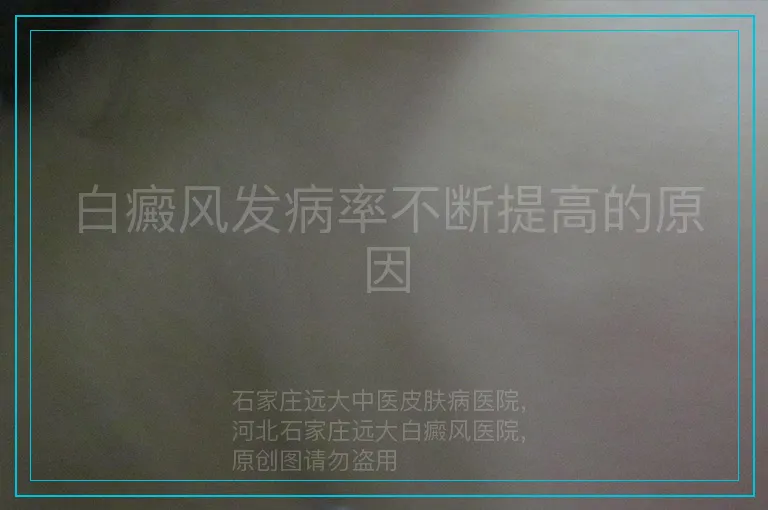 白癜风发病率不断提高的原因