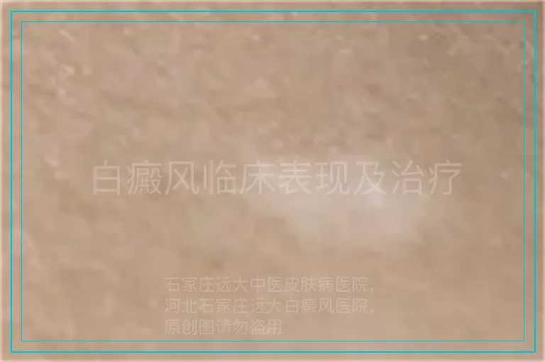 白癜风临床表现及治疗