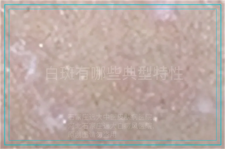 白斑有哪些典型特性