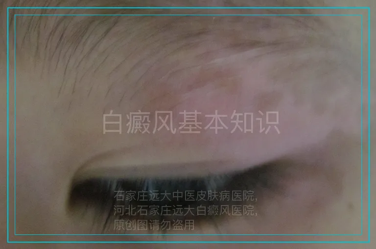 白癜风基本知识