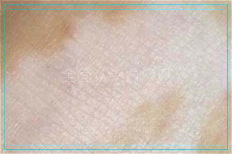 全面认识白癜风