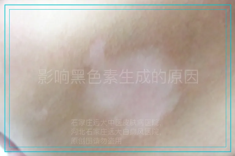 影响黑色素生成的原因