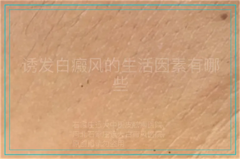诱发白癜风的生活因素有哪些