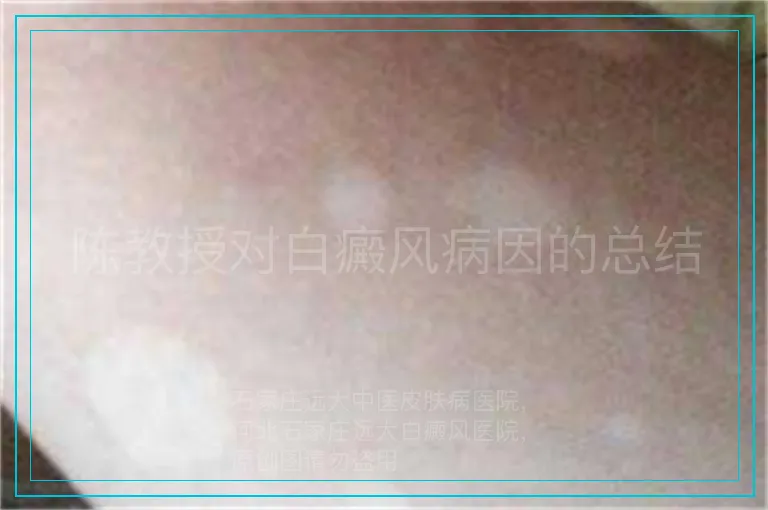 陈教授对白癜风病因的总结