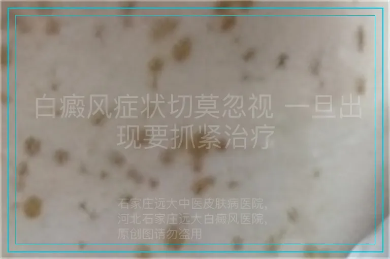 白癜风症状切莫忽视 一旦出现要抓紧治疗