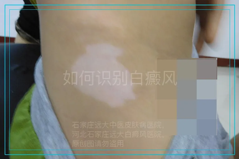 如何识别白癜风