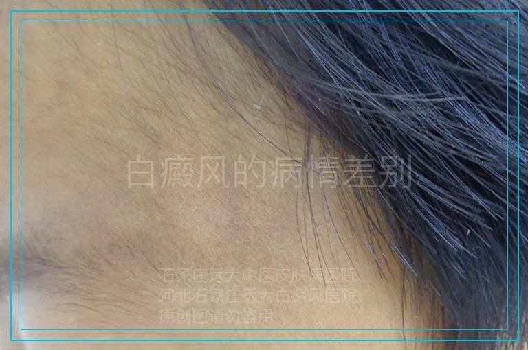 白癜风的病情差别