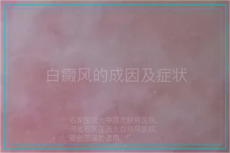 白癜风的成因及症状