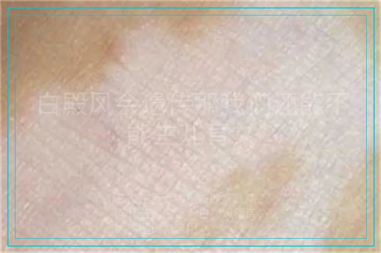 白殿风会遗传那我们还能不能生儿育女