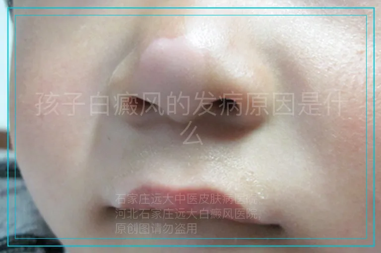 孩子白癜风的发病原因是什么
