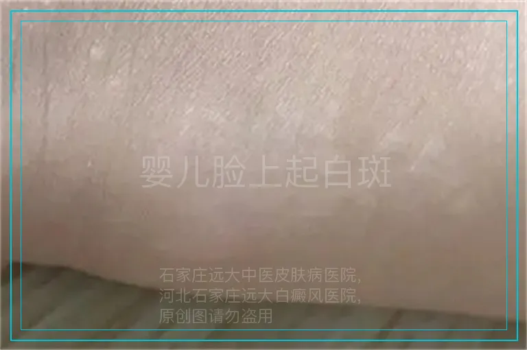 婴儿脸上起白斑