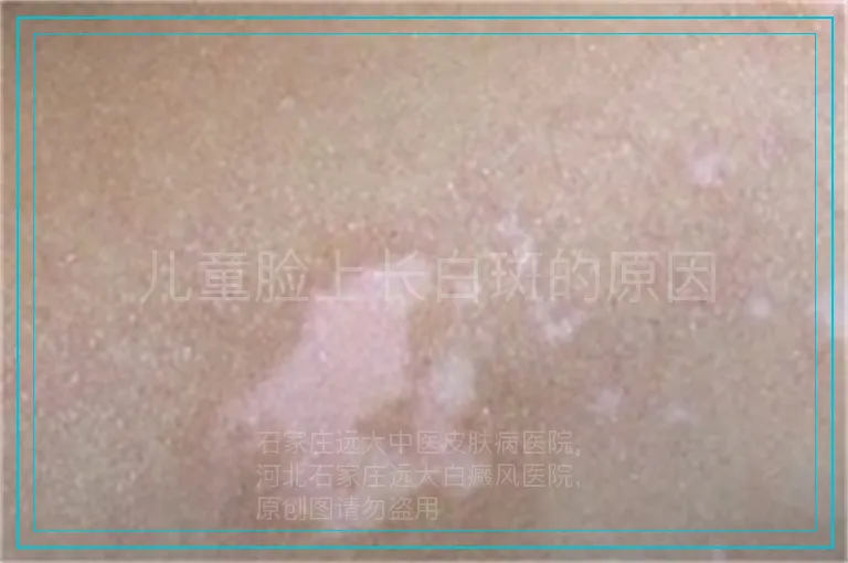 儿童脸上长白斑的原因