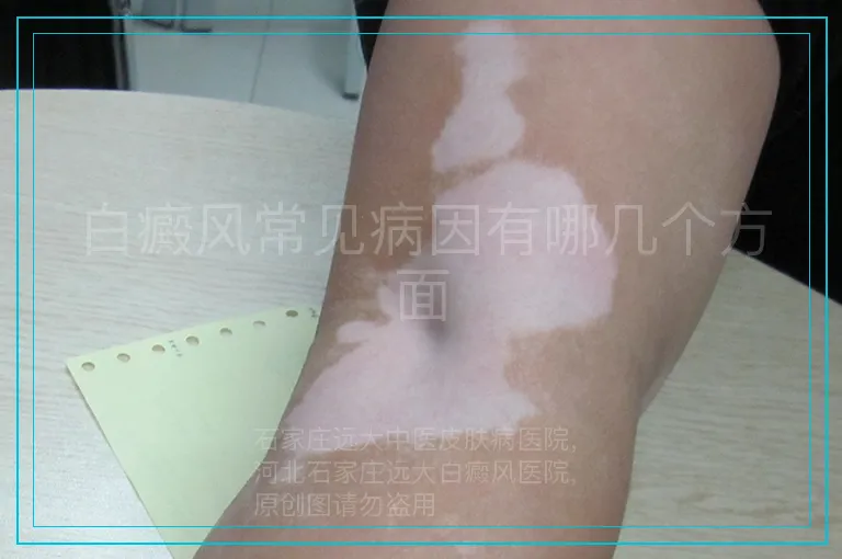 白癜风常见病因有哪几个方面