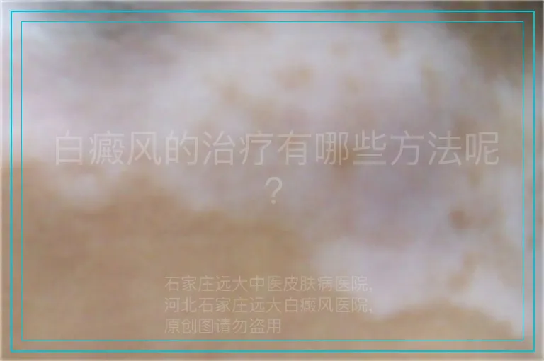 白癜风的治疗有哪些方法呢?