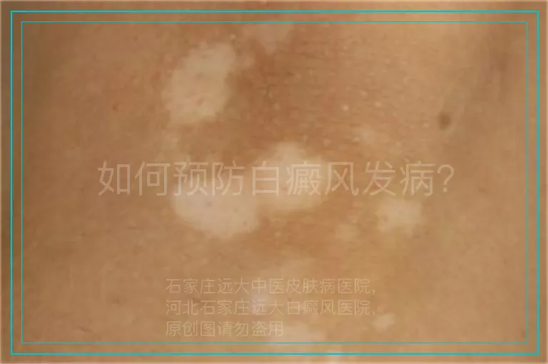 如何预防白癜风发病？
