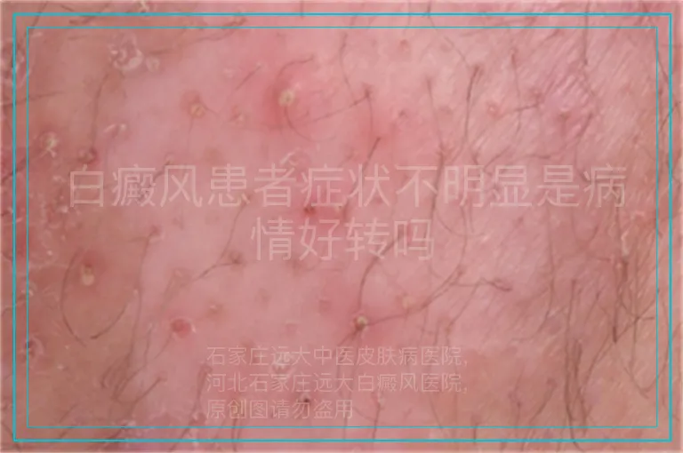 白癜风患者症状不明显是病情好转吗