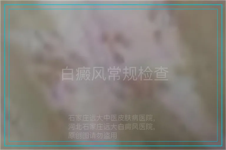白癜风常规检查