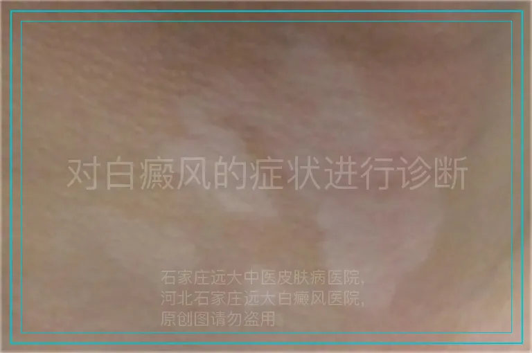 对白癜风的症状进行诊断
