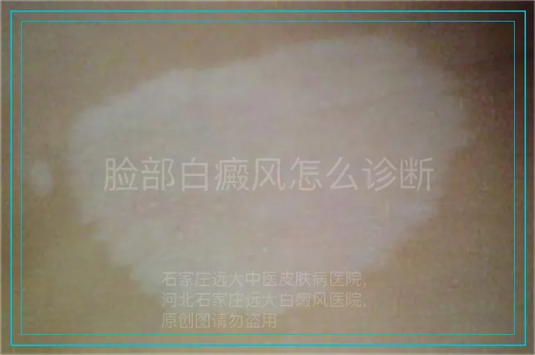 脸部白癜风怎么诊断