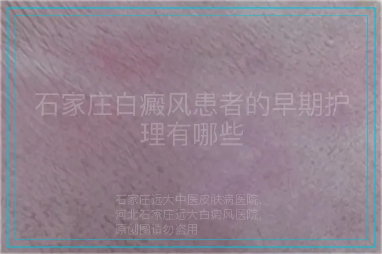 石家庄白癜风患者的早期护理有哪些