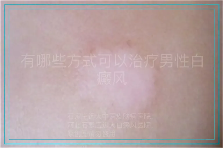 有哪些方式可以治疗男性白癜风