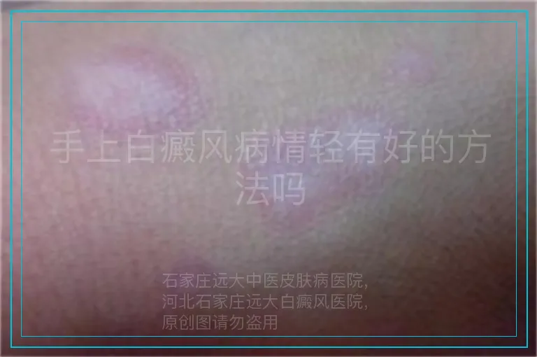 手上白癜风病情轻有好的方法吗