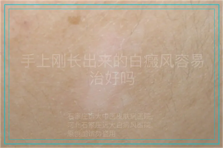 手上刚长出来的白癜风容易治好吗