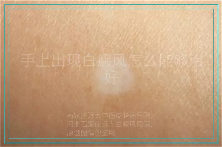 手上出现白癜风怎么能够治好