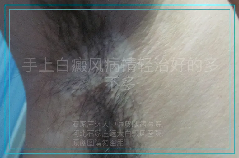 手上白癜风病情轻治好的多不多