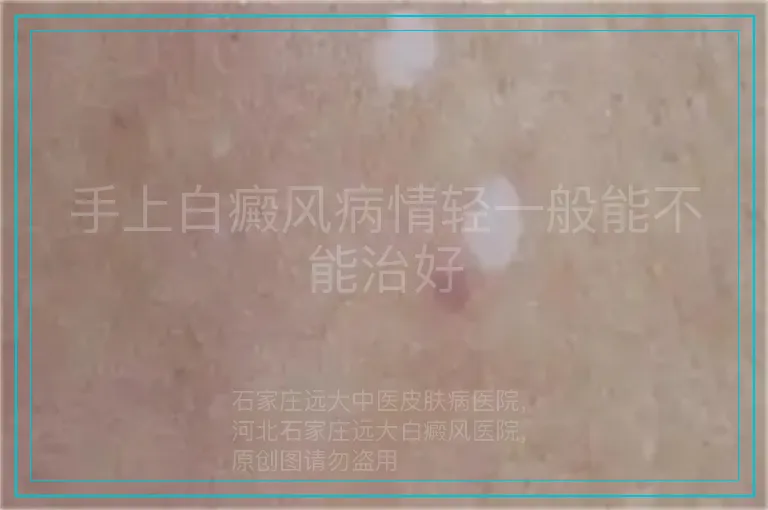 手上白癜风病情轻一般能不能治好