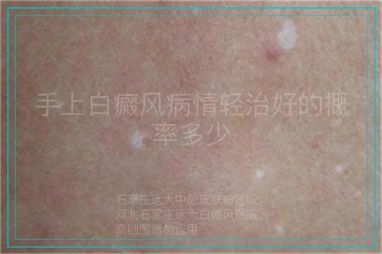 手上白癜风病情轻治好的概率多少