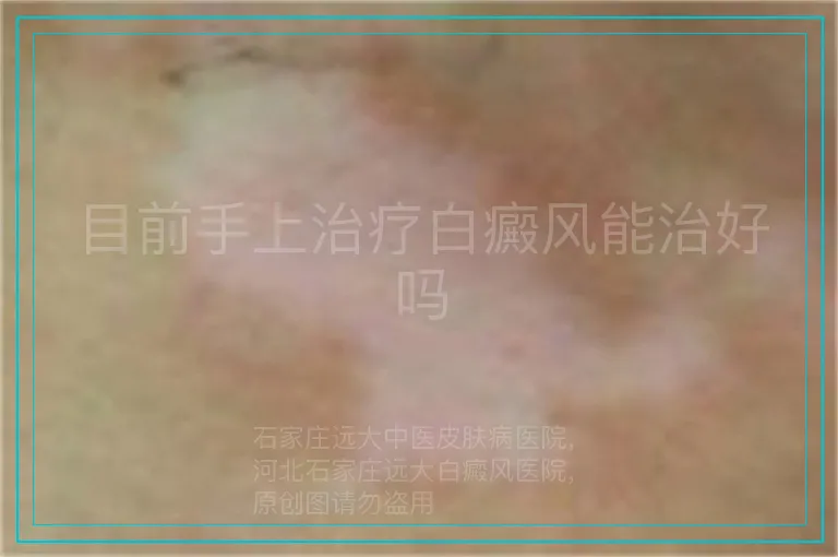 目前手上治疗白癜风能治好吗