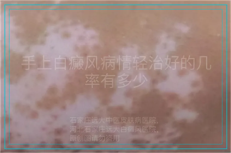 手上白癜风病情轻治好的几率有多少