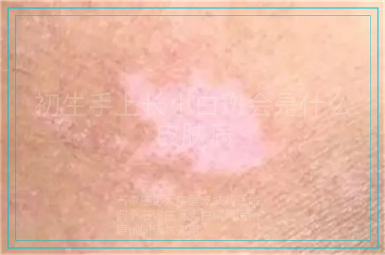 初生手上长小白斑会是什么皮肤病