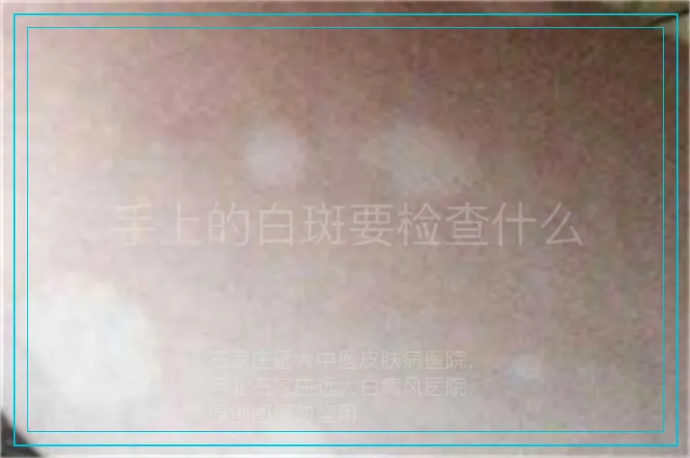 手上的白斑要检查什么