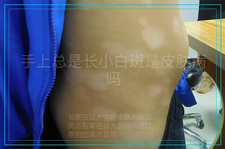 手上总是长小白斑是皮肤病吗