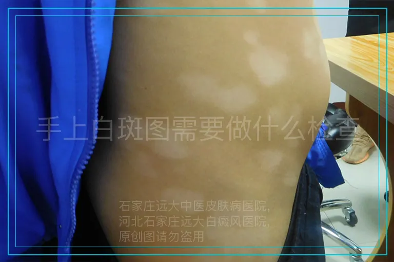 手上白斑图需要做什么检查