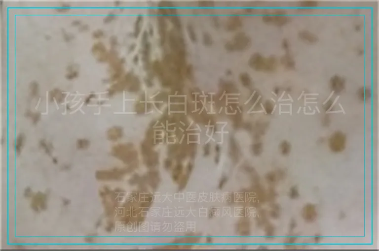小孩手上长白斑怎么治怎么能治好