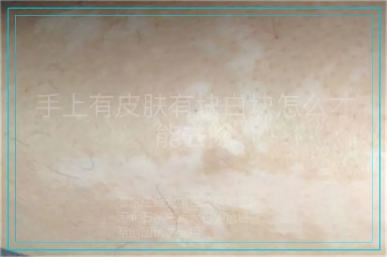 手上有皮肤有块白块怎么才能去除