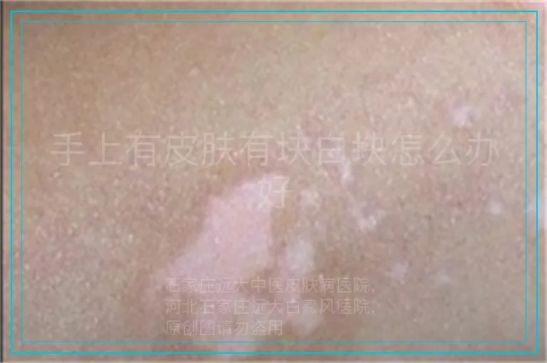 手上有皮肤有块白块怎么办好