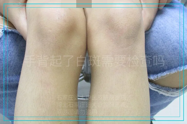 手背起了白斑需要检查吗
