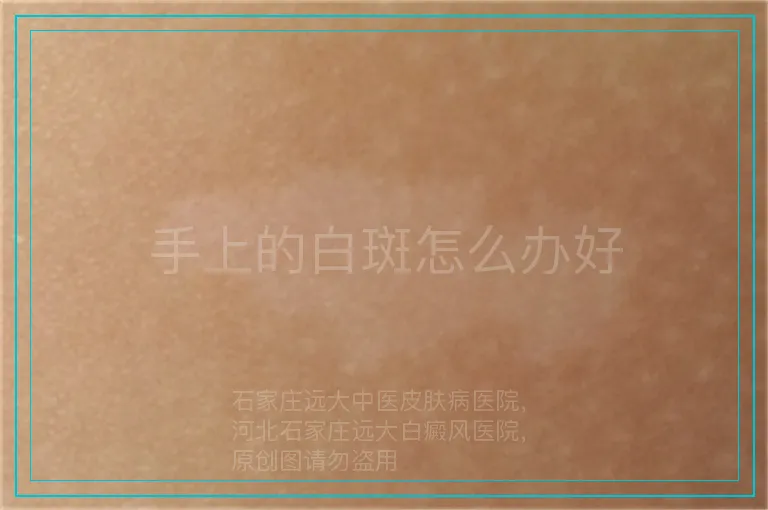 手上的白斑怎么办好
