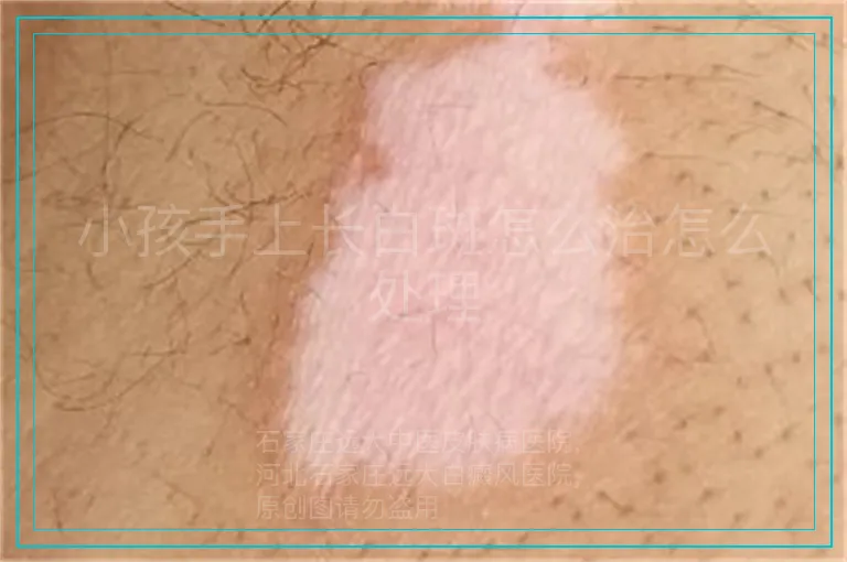 小孩手上长白斑怎么治怎么处理