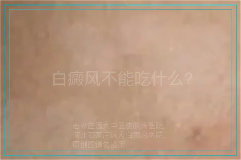 白癜风不能吃什么?
