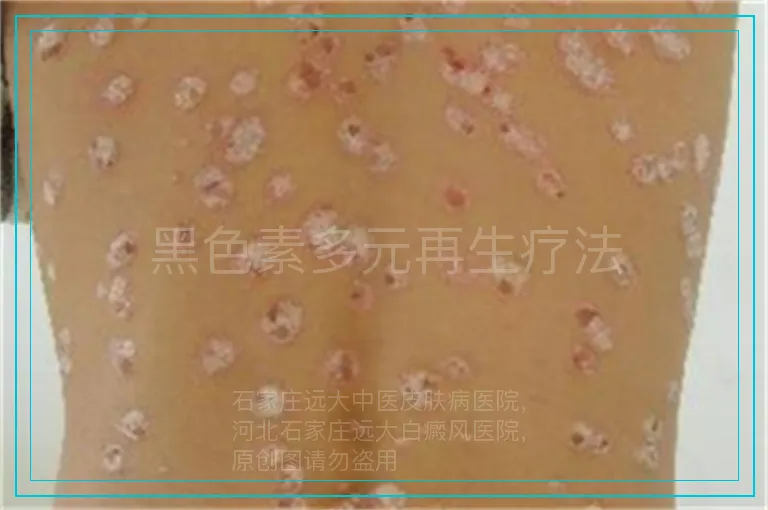 黑色素多元再生疗法