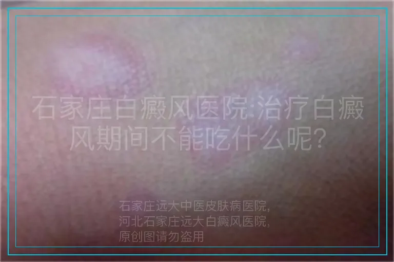 石家庄白癜风医院:治疗白癜风期间不能吃什么呢?