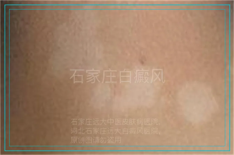 石家庄白癜风